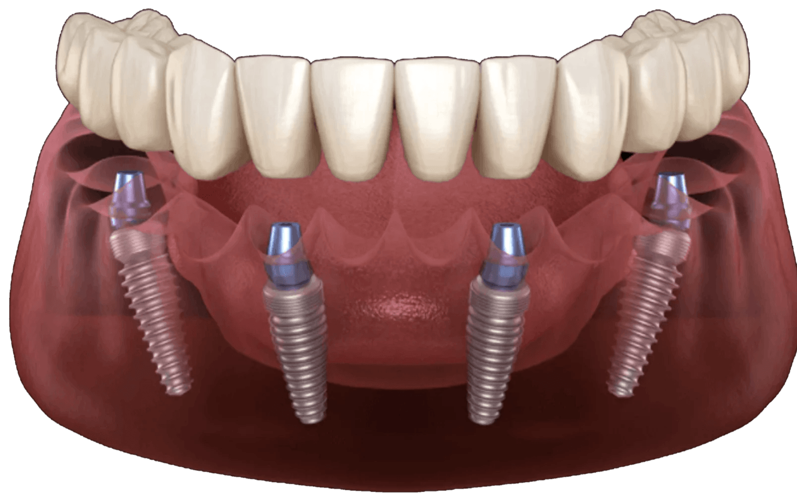 ALL on 4(6) имплантация