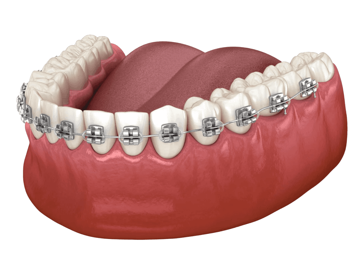 Брекет-системы