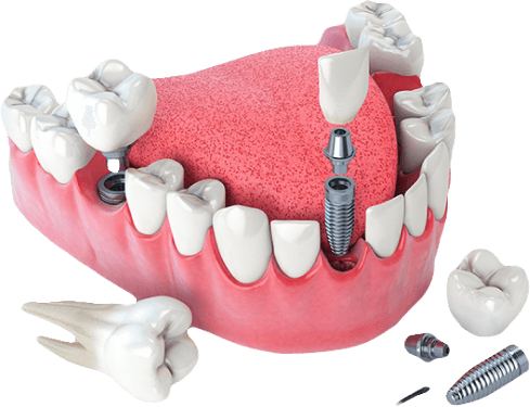 Имплантация зубов