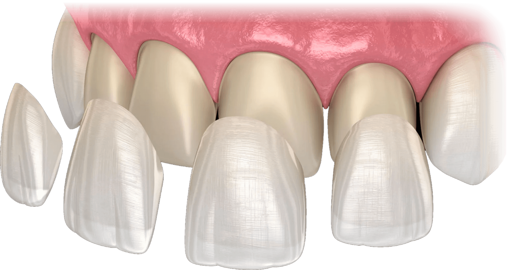 Керамические виниры