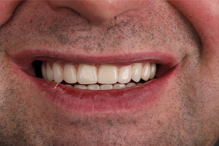 ПРОТЕЗИРОВАНИЕ ALL-ON-4