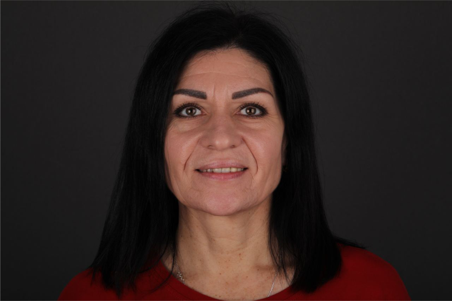 ПРОТЕЗИРОВАНИЕ ALL-ON-4