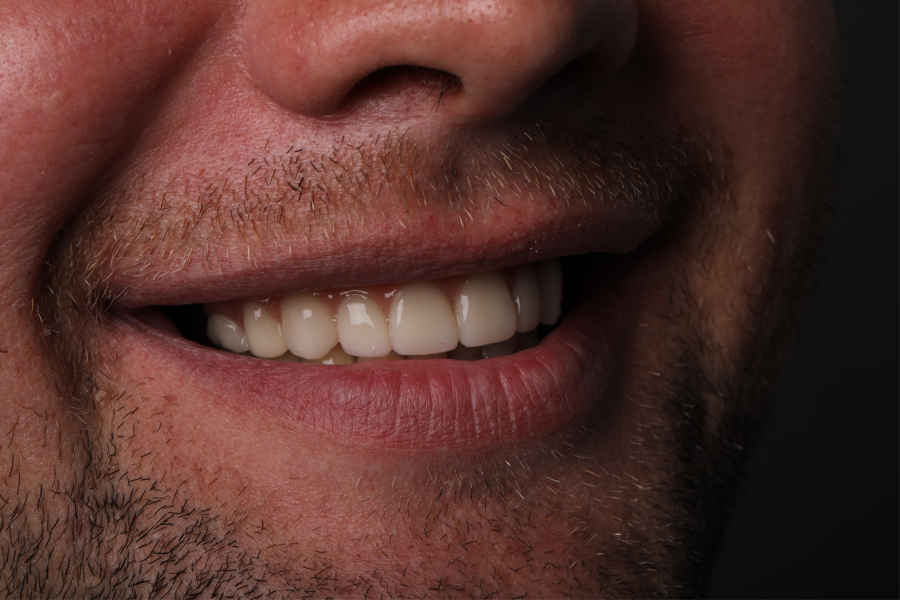 ПРОТЕЗИРОВАНИЕ ALL-ON-4