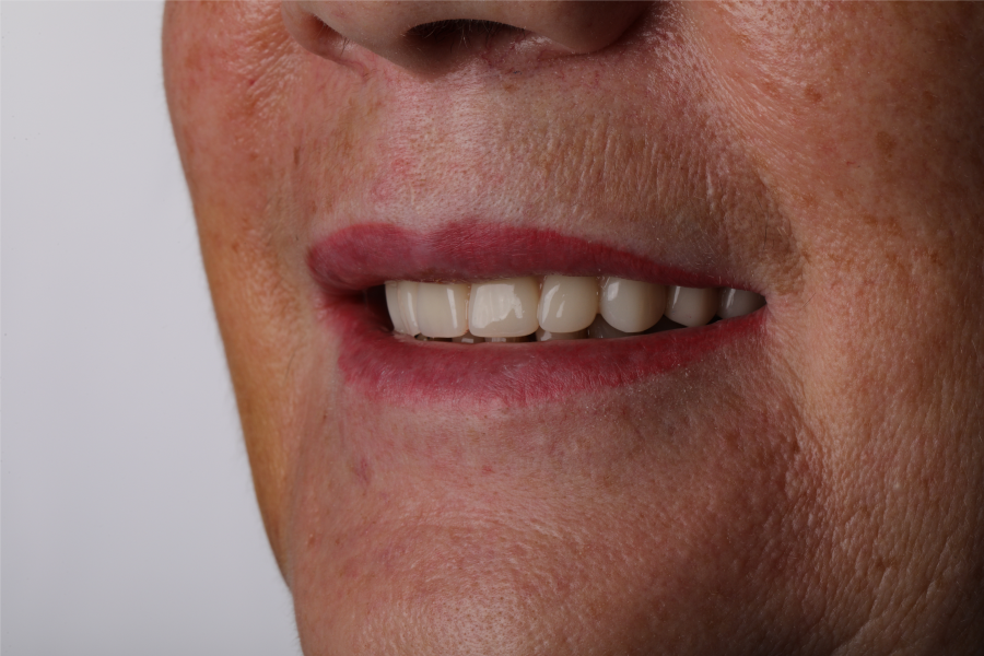 ПРОТЕЗИРОВАНИЕ ALL-ON-4