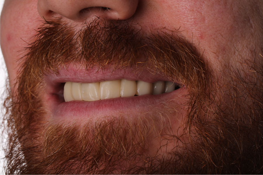 ПРОТЕЗИРОВАНИЕ ALL-ON-6