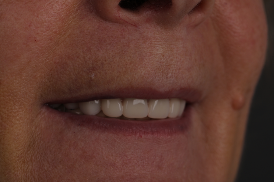 ПРОТЕЗИРОВАНИЕ ALL-ON-4